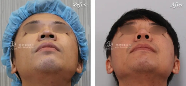 男性隆鼻+下巴手術案例,博恩妍